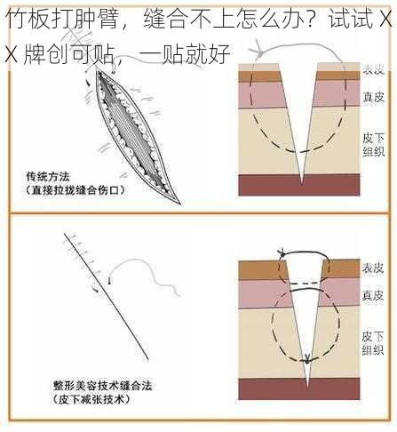 竹板打肿臂，缝合不上怎么办？试试 XX 牌创可贴，一贴就好