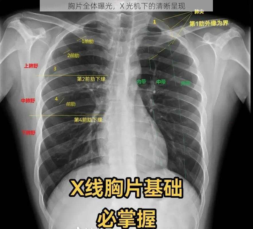 胸片全体曝光，X 光机下的清晰呈现